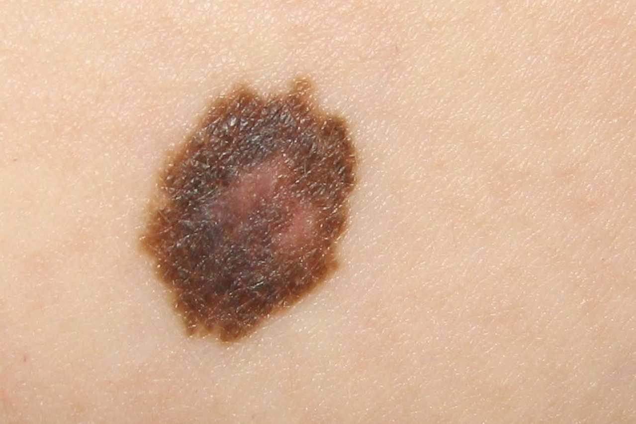 skin-cancer-pictures-most-common-skin-cancer-types-with-images