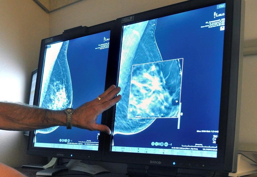 A file photo shows a mammogram