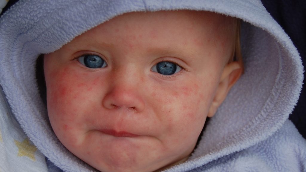 Toronto health officials investigating after infant hospitalized with measles