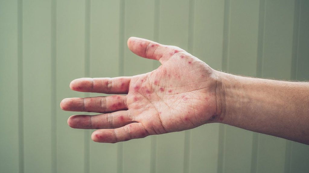 A patient's hand with measles