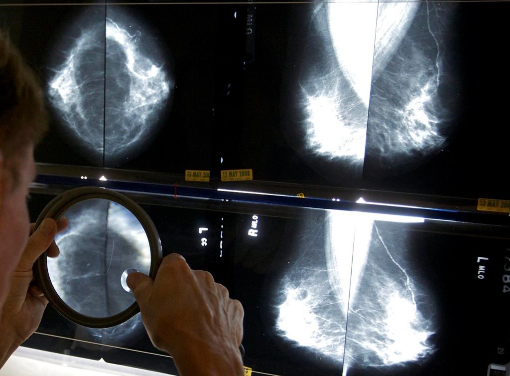 Breast cancer screening should start at age 40, Canadian Cancer Society says