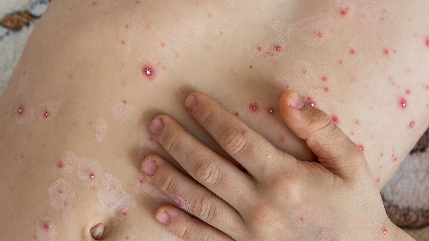 Ontario seeing rise in Mpox cases: public health agency