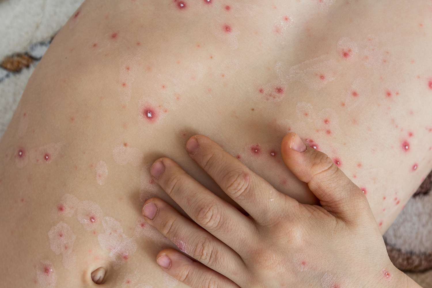 Ontario seeing rise in Mpox cases: public health agency